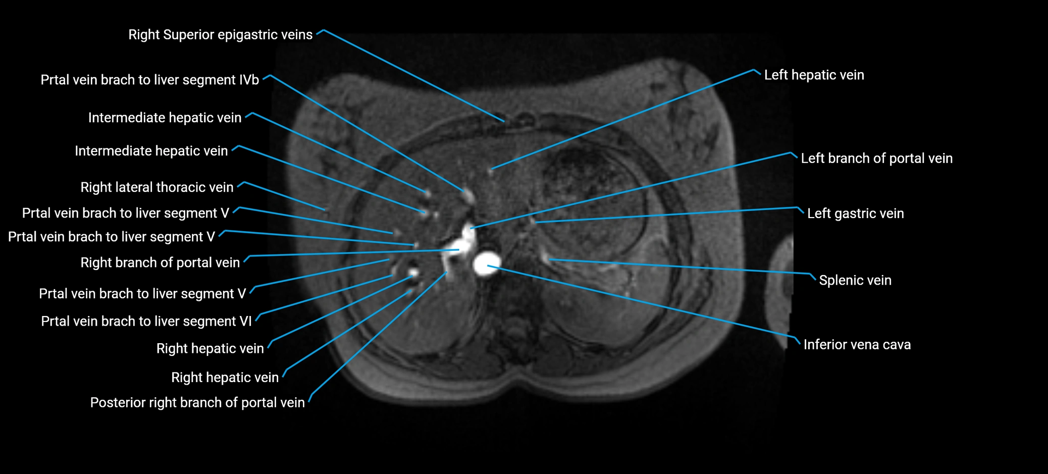 MRV abdomen pelvis & lower limb axial cross sectional anatomy labelled MRI image 40 (1).webp